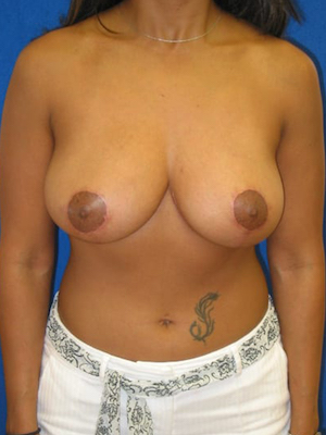 after breast reduction